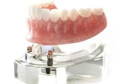 Implant-retained denture model