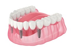 Illustration of an implant denture