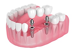a computer model of an implant bridge