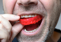 Closeup of man removing red mouthguard from upper arch