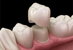 Dental crown placement animation