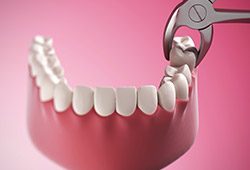 Animation of tooth removal
