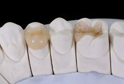 Tooth-colored filling model