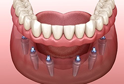 Implant-retained denture illustration