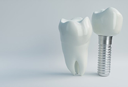 model of a real tooth next to a dental implant in Stephens City