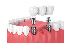 two dental implants with a dental bridge