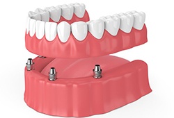 full denture on top of four implants