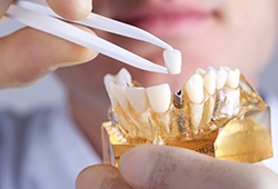 dentist placing a crown on a model of a dental implant within the jaw