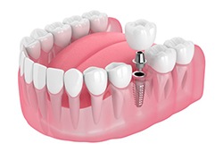 single dental implant being placed in the lower jaw