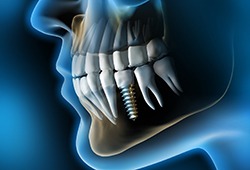 X-ray of a patient with a single dental implant 