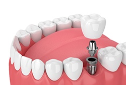 single dental implant with a crown