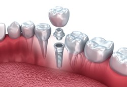 single unit implant