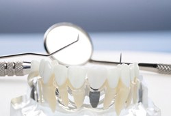 a model of a dental implant