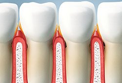 Inflamed gum tissue animation