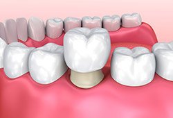 Animation of dental crown placement