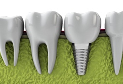 Model of dental implant