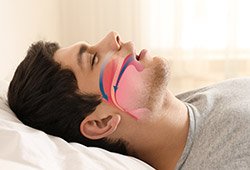 Sleeping man with airway animation over profile