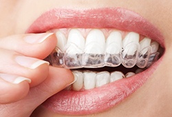 A closeup of a mouth placing a teeth whitening tray