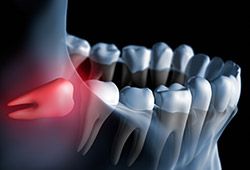 Animation of impacted wisdom tooth