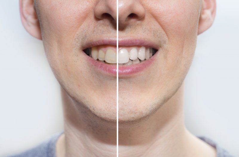 Before and after of a man’s tooth color in Stephens City