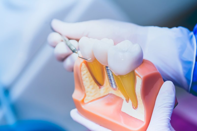 A dentist showing their patient a model of a dental implant