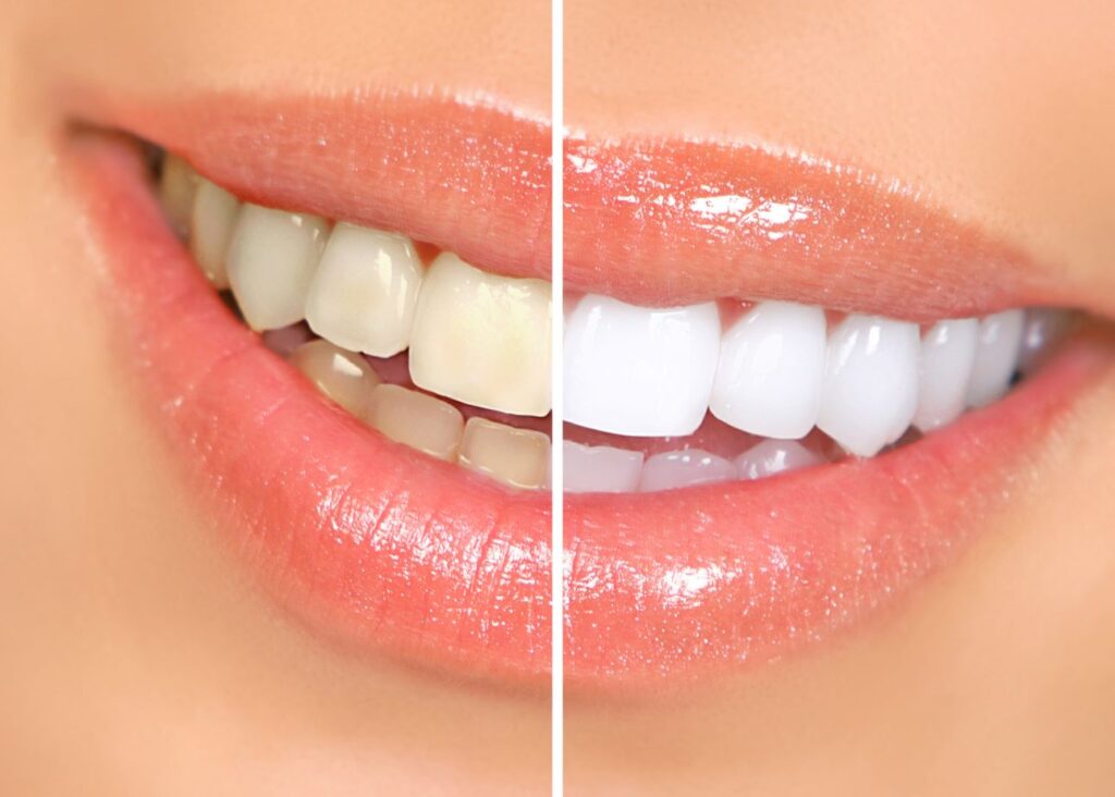 Closeup of smile with sparkly gloss halved to show results of teeth whitening